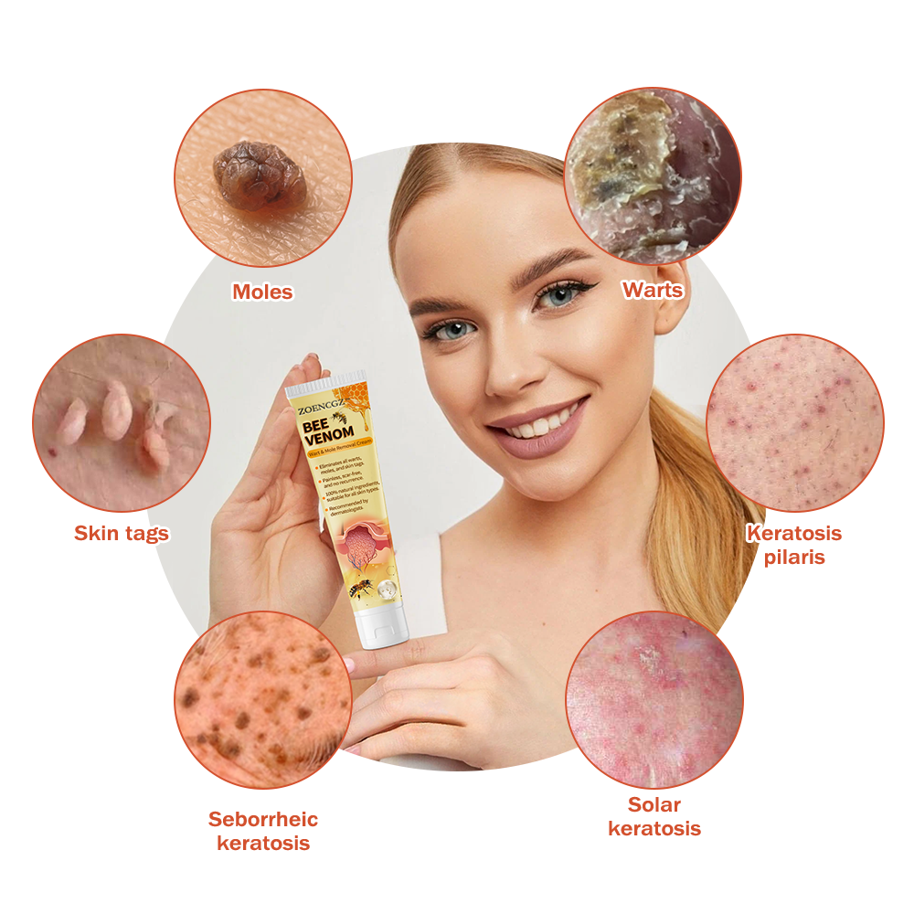 𝐙𝐨𝐞𝐧𝐜𝐠𝐳™ 𝐁𝐞𝐞 𝐕𝐞𝐧𝐨𝐦 𝐌𝐨𝐥𝐞 𝐚𝐧𝐝 𝐖𝐚𝐫𝐭 𝐓𝐫𝐞𝐚𝐭𝐦𝐞𝐧𝐭 𝐂𝐫𝐞𝐚𝐦(👨‍⚕𝐀𝐀𝐃 𝐑𝐄𝐂𝐎𝐌𝐌𝐄𝐍𝐃𝐒)